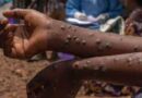 Ghana Confirms 20 New Mpox Cases, Bringing Total to 302